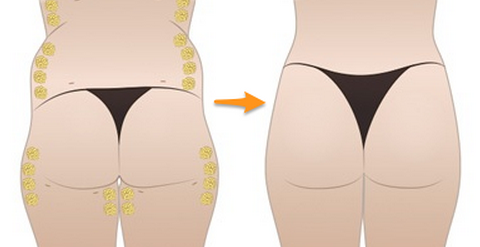 自體脂肪豐臀后會不會變形呢？自體脂肪豐臀的優(yōu)缺點(diǎn)有哪些？