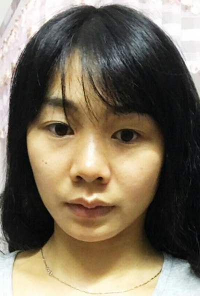 廈門華美名媛整形美容醫(yī)院做雙眼皮手術(shù)前的眼睛