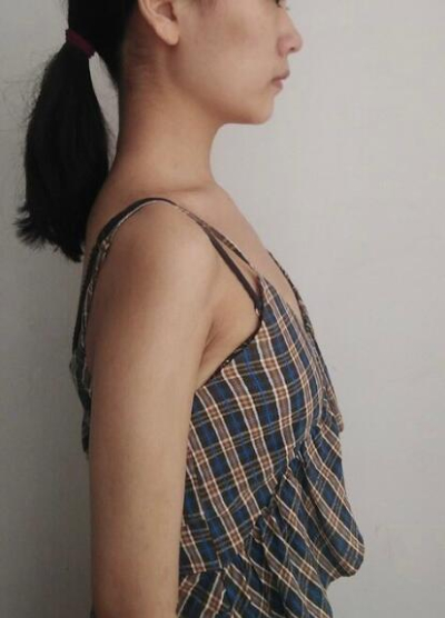 隆胸手術前上海藝星醫(yī)療美容醫(yī)院做隆胸手術前 隆胸手術前上海藝星醫(yī)療美容醫(yī)院做隆胸手術前