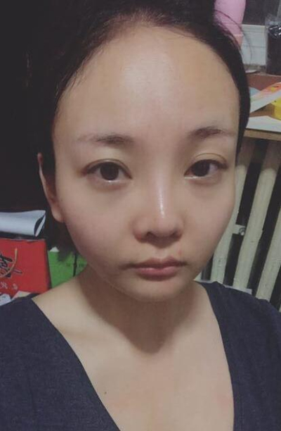 煙臺韓美美容整形外科診所金東浩熱瑪吉案例效果分享