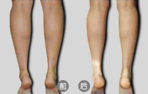 隔空溶脂瘦小腿后如何術后護理  隔空溶脂瘦小腿多少錢
