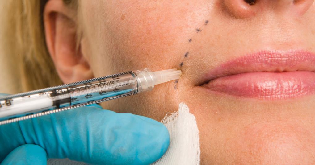 少女針是什么？少女針和玻尿酸填充哪個好？