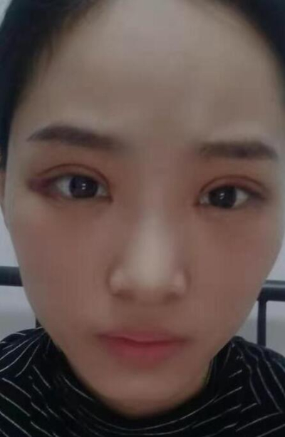 長(zhǎng)沙星雅醫(yī)療美容醫(yī)院做雙眼皮手術(shù)后恢復(fù)情況 長(zhǎng)沙星雅醫(yī)療美容醫(yī)院做雙眼皮手術(shù)后恢復(fù)情況