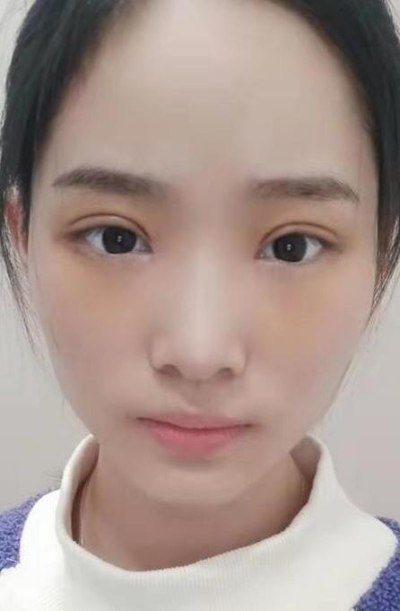 長(zhǎng)沙星雅醫(yī)療美容醫(yī)院做雙眼皮的最終手術(shù)效果 長(zhǎng)沙星雅醫(yī)療美容醫(yī)院做雙眼皮的最終手術(shù)效果