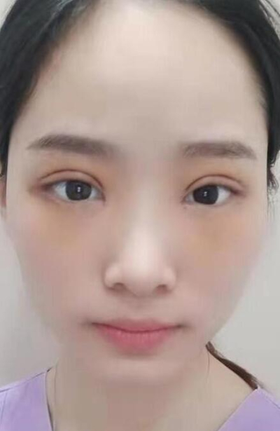 長(zhǎng)沙星雅醫(yī)療美容醫(yī)院做雙眼皮手術(shù)后的大眼 長(zhǎng)沙星雅醫(yī)療美容醫(yī)院做雙眼皮手術(shù)后的大眼