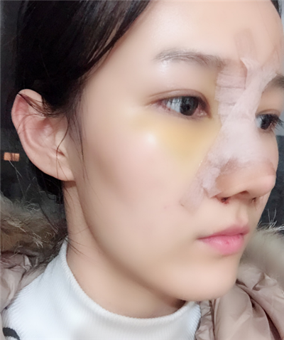 長春中妍醫(yī)療美容醫(yī)院隆鼻手術(shù)后的效果 長春中妍醫(yī)療美容醫(yī)院隆鼻手術(shù)后的效果