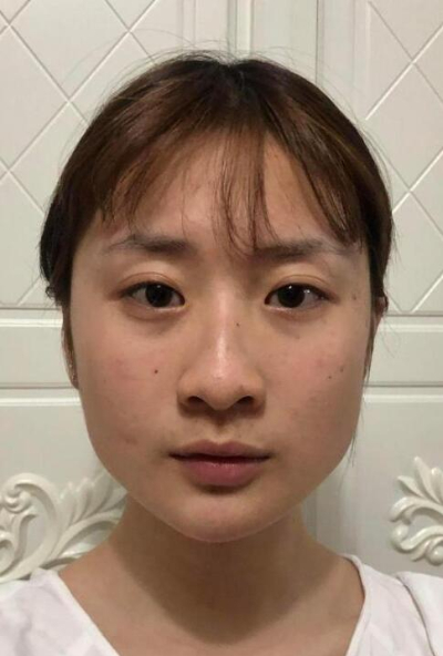 珠海陸達(dá)美容外科醫(yī)院做下頜角手術(shù)前的鼻子 珠海陸達(dá)美容外科醫(yī)院做下頜角手術(shù)前的鼻子