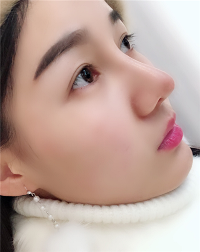 長春中妍醫(yī)療美容醫(yī)院隆鼻手術(shù)后鼻子情況基本穩(wěn)定 長春中妍醫(yī)療美容醫(yī)院隆鼻手術(shù)后鼻子情況基本穩(wěn)定