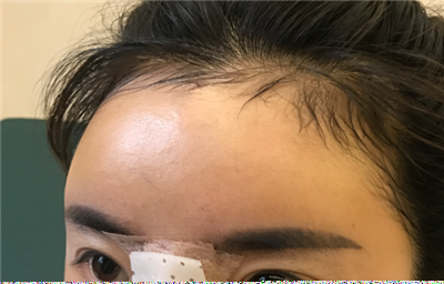 煙臺壹美整形美容醫(yī)院做隆鼻手術(shù)后的鼻子狀態(tài) 煙臺壹美整形美容醫(yī)院做隆鼻手術(shù)后的鼻子狀態(tài)