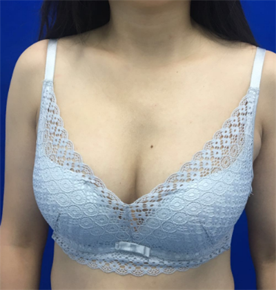 煙臺(tái)壹美整形美容醫(yī)院做隆胸手術(shù)后半個(gè)月的情形