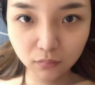 寧波尚美整形美容醫(yī)院齊強(qiáng)隆鼻案例效果分享
