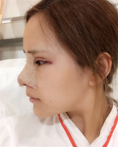 深圳弘美醫(yī)療美容門診部做眼綜合手術(shù)后