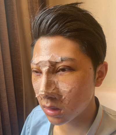 長春中妍醫(yī)療美容醫(yī)院做鼻綜合手術(shù)后 長春中妍醫(yī)療美容醫(yī)院做鼻綜合手術(shù)后