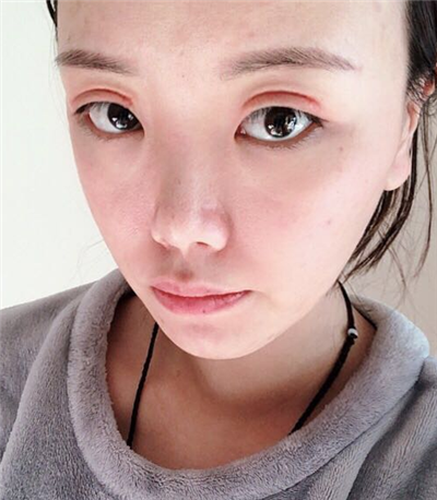 珠海韓妃醫(yī)療美容門(mén)診部做雙眼皮術(shù)后的最終情況