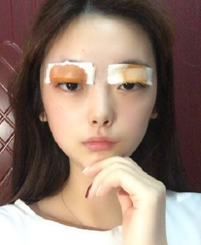 安徽韓美整形美容醫(yī)院做雙眼皮手術(shù)結(jié)束后