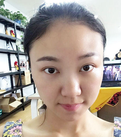 蘇州同濟(jì)醫(yī)院整形美容中心做去眼袋手術(shù)后的眼部狀態(tài) 蘇州同濟(jì)醫(yī)院整形美容中心做去眼袋手術(shù)后的眼部狀態(tài)