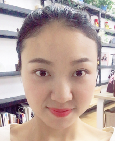 蘇州同濟(jì)醫(yī)院整形美容中心做去眼袋手術(shù)后的第15天 蘇州同濟(jì)醫(yī)院整形美容中心做去眼袋手術(shù)后的第15天