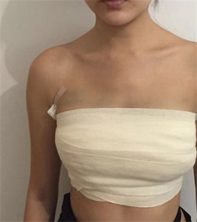  寧波珈禾整形?？漆t(yī)院雷中元隆胸案例效果分享