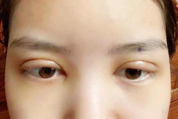 鄭州壹加壹王洛生全切雙眼皮案例術后一周 鄭州壹加壹王洛生全切雙眼皮案例術后一周