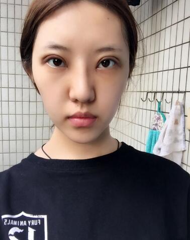 第四軍醫(yī)大學(xué)唐都醫(yī)院李望舟雙眼皮案例術(shù)后一個(gè)月效果 第四軍醫(yī)大學(xué)唐都醫(yī)院李望舟雙眼皮案例術(shù)后一個(gè)月效果