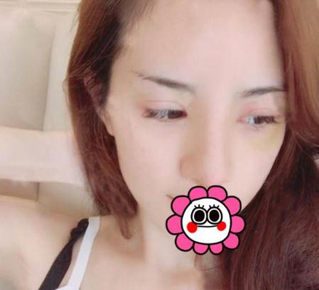 宜昌奧萊整形楊群申膨體隆鼻案例術(shù)后十天效果