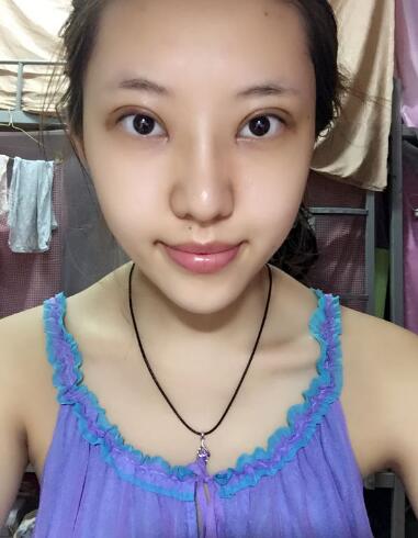 第四軍醫(yī)大學(xué)唐都醫(yī)院李望舟雙眼皮案例術(shù)后一個(gè)月 第四軍醫(yī)大學(xué)唐都醫(yī)院李望舟雙眼皮案例術(shù)后一個(gè)月