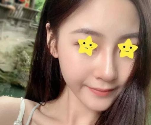 做綜合鼻，上海首爾麗格安建榮鼻綜合真人案例照片