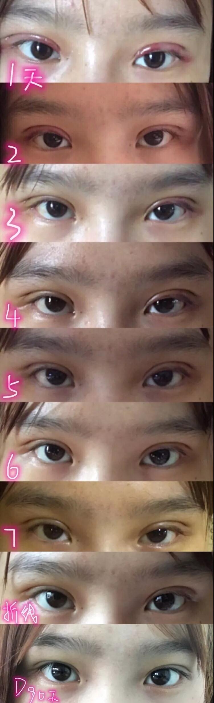 濟南坤如瑪麗崔金珍雙眼皮案例術(shù)后效果