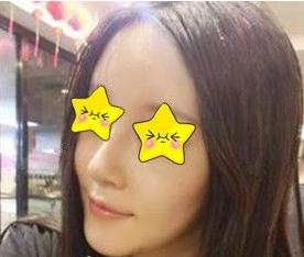 長沙亞韓鄭京湘隆鼻術(shù)后一個月 長沙亞韓鄭京湘隆鼻術(shù)后一個月