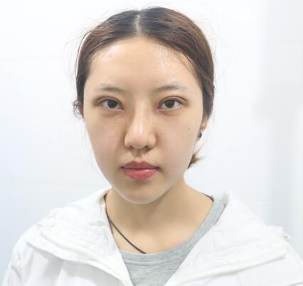 第四軍醫(yī)大學(xué)唐都醫(yī)院李望舟雙眼皮案例術(shù)后一周 第四軍醫(yī)大學(xué)唐都醫(yī)院李望舟雙眼皮案例術(shù)后一周