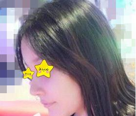 隆鼻真實案例，長沙亞韓鄭京湘隆鼻前后對比圖片