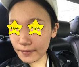 隆鼻真實案例，長沙亞韓鄭京湘隆鼻前后對比圖片