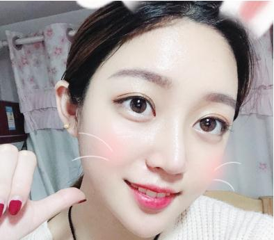 宜昌奧萊楊群申超體隆鼻案例分享，有圖