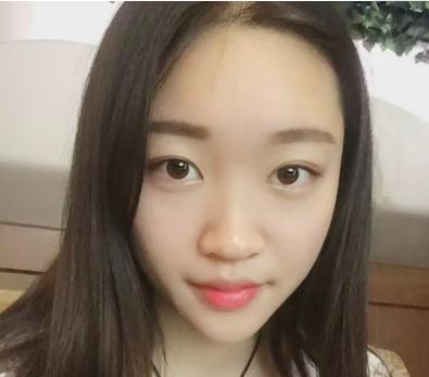 宜昌奧萊楊群申超體隆鼻案例術(shù)前 宜昌奧萊楊群申超體隆鼻案例術(shù)前