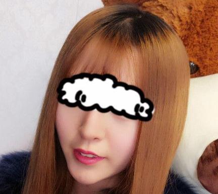 北京聯(lián)合麗格卓彥醫(yī)療趙瓊隆鼻失敗修復(fù)手術(shù)案例術(shù)后一個(gè)半月 北京聯(lián)合麗格卓彥醫(yī)療趙瓊隆鼻失敗修復(fù)手術(shù)案例術(shù)后一個(gè)半月