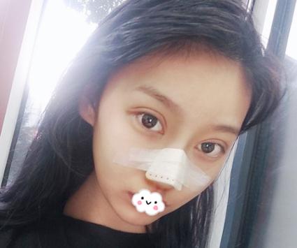 在上海伊美爾港華做假體隆鼻術(shù)后兩天效果