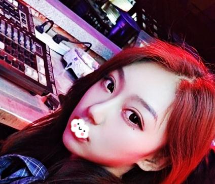 在上海伊美爾港華做假體隆鼻術(shù)后一個(gè)月效果