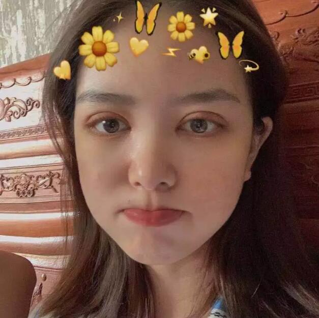 鄭州壹加壹王洛生全切雙眼皮案例術后半個月 鄭州壹加壹王洛生全切雙眼皮案例術后半個月