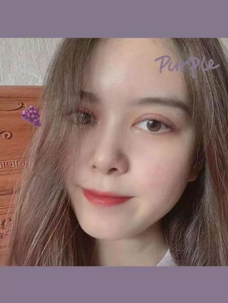 鄭州壹加壹王洛生全切雙眼皮案例術后三個月 鄭州壹加壹王洛生全切雙眼皮案例術后三個月