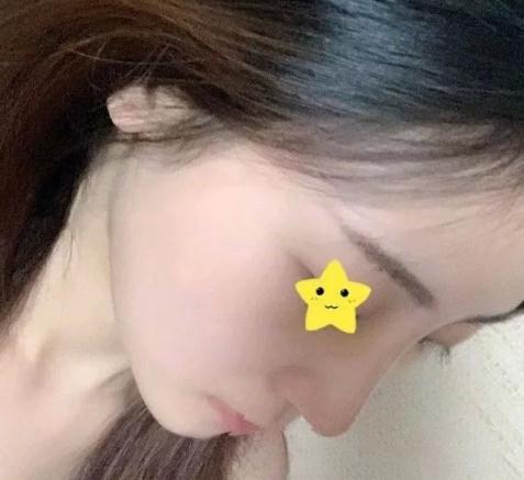 上海首爾麗格安建榮鼻綜合真人案例術后一個月右側