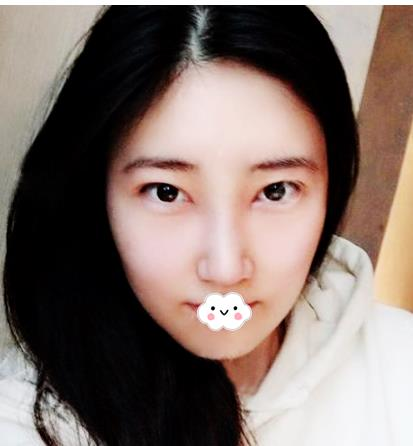 假體隆鼻假嗎？假體隆鼻三個(gè)月效果分享