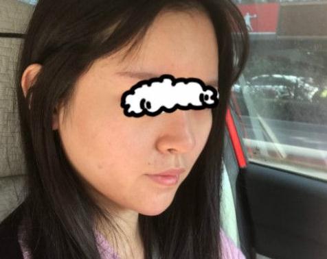 北京聯(lián)合麗格卓彥醫(yī)療趙瓊隆鼻失敗修復(fù)手術(shù)案例術(shù)后半個(gè)月 北京聯(lián)合麗格卓彥醫(yī)療趙瓊隆鼻失敗修復(fù)手術(shù)案例術(shù)后半個(gè)月