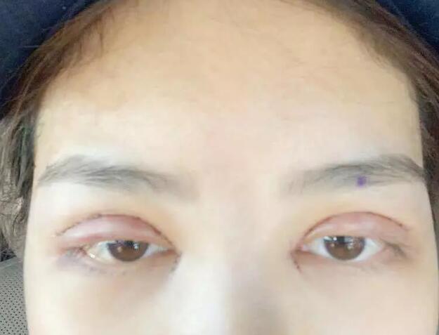 鄭州壹加壹王洛生全切雙眼皮案例術后第二天 鄭州壹加壹王洛生全切雙眼皮案例術后第二天