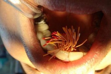 撫州英倫口腔根管治療怎么樣？根管治療有什么優(yōu)點(diǎn)？