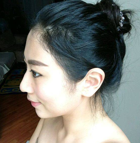 南京美貝爾醫(yī)療美容醫(yī)院做假體隆鼻術(shù)后一個月的形態(tài)