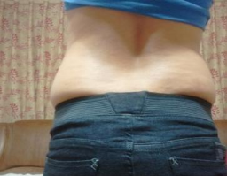 東莞華美醫(yī)療美容醫(yī)院劉潤(rùn)貴做腰腹吸脂案例效果分享