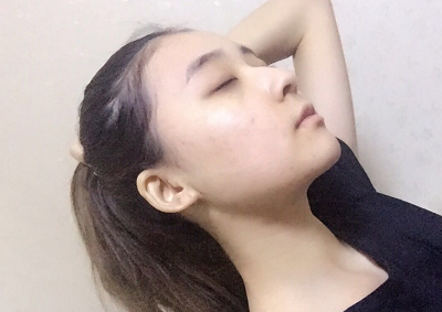 北京京民醫(yī)院(原釣魚臺醫(yī)院)整形外科做下頜骨手術(shù)后去掉頭套 北京京民醫(yī)院(原釣魚臺醫(yī)院)整形外科做下頜骨手術(shù)后去掉頭套