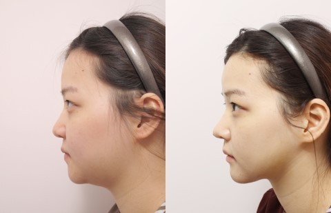 面部吸脂最好的辦法是什么？做一次面部吸脂多少錢(qián)？