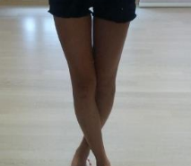 東莞華美醫(yī)療美容醫(yī)院劉潤(rùn)貴做腰腹吸脂案例效果分享