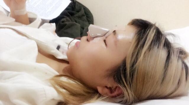 成都蜀尚蓉雅美容整形醫(yī)院做鼻綜合手術(shù)剛剛結(jié)束后的側(cè)面